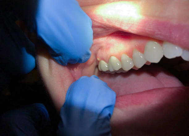Best Dental Abscess Treatment in Jamestown, CA