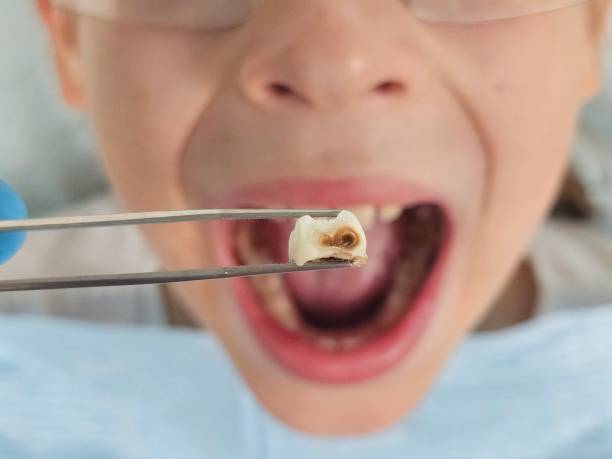 Best Knocked-Out Tooth (Avulsed Tooth) Treatment in Jamestown, CA
